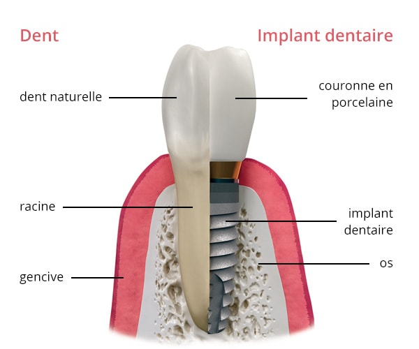 Implant Dentaire