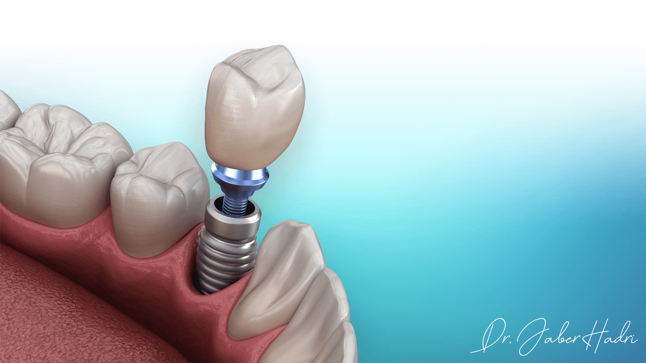 Implants Dentaires